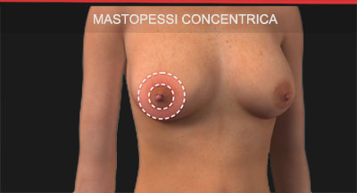Mastopessi concentrica